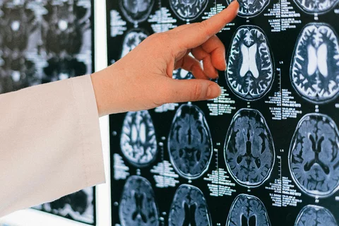 image of a medical brain scan with 4 small scan rows across and 5 rows down featuring various brain images. there is a finger pointing to the second row